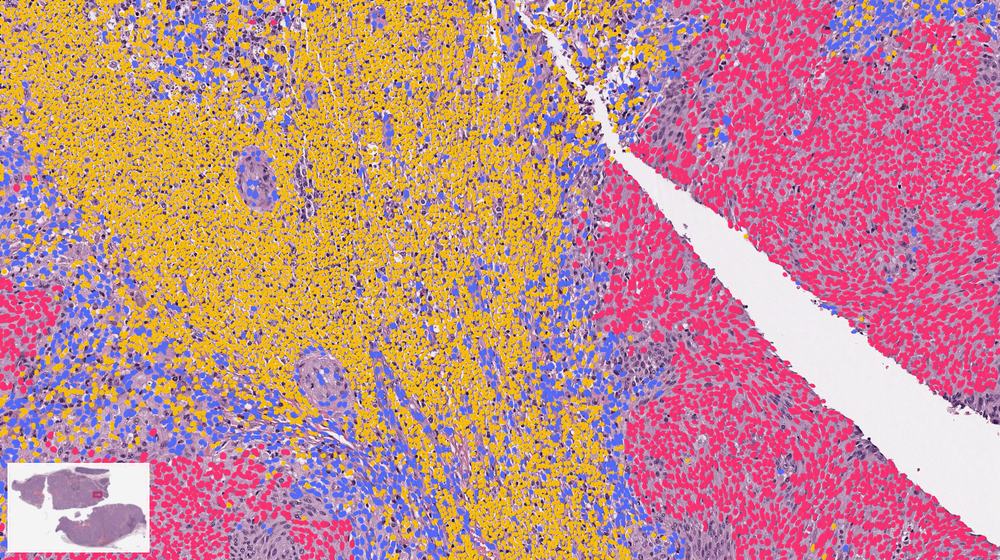 The same field read by CHAI: every cell outlined and colored by type, tumor cells pink, immune cells yellow, stromal cells blue.