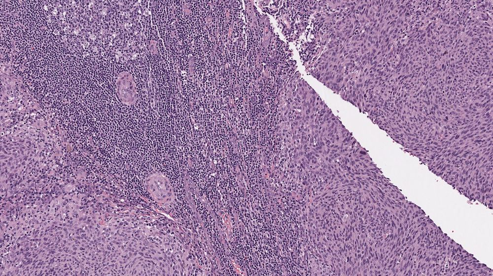 A melanoma tissue section stained pink and purple, as it looks to the eye under the microscope: a dense sheet of tumor cells beside a band of immune cells.